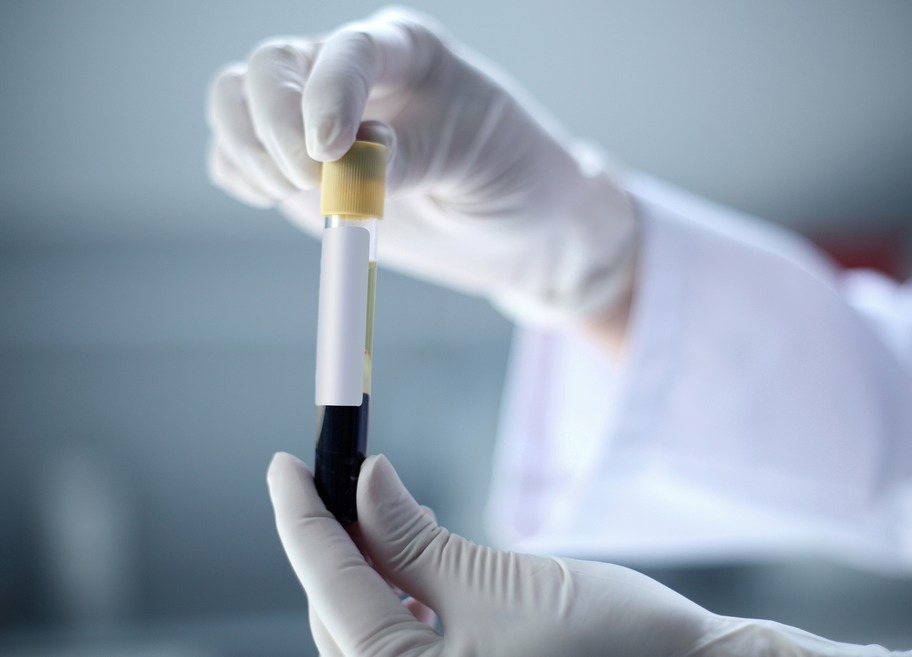 5 Must-do Blood Tests for Every Middle Aged Man